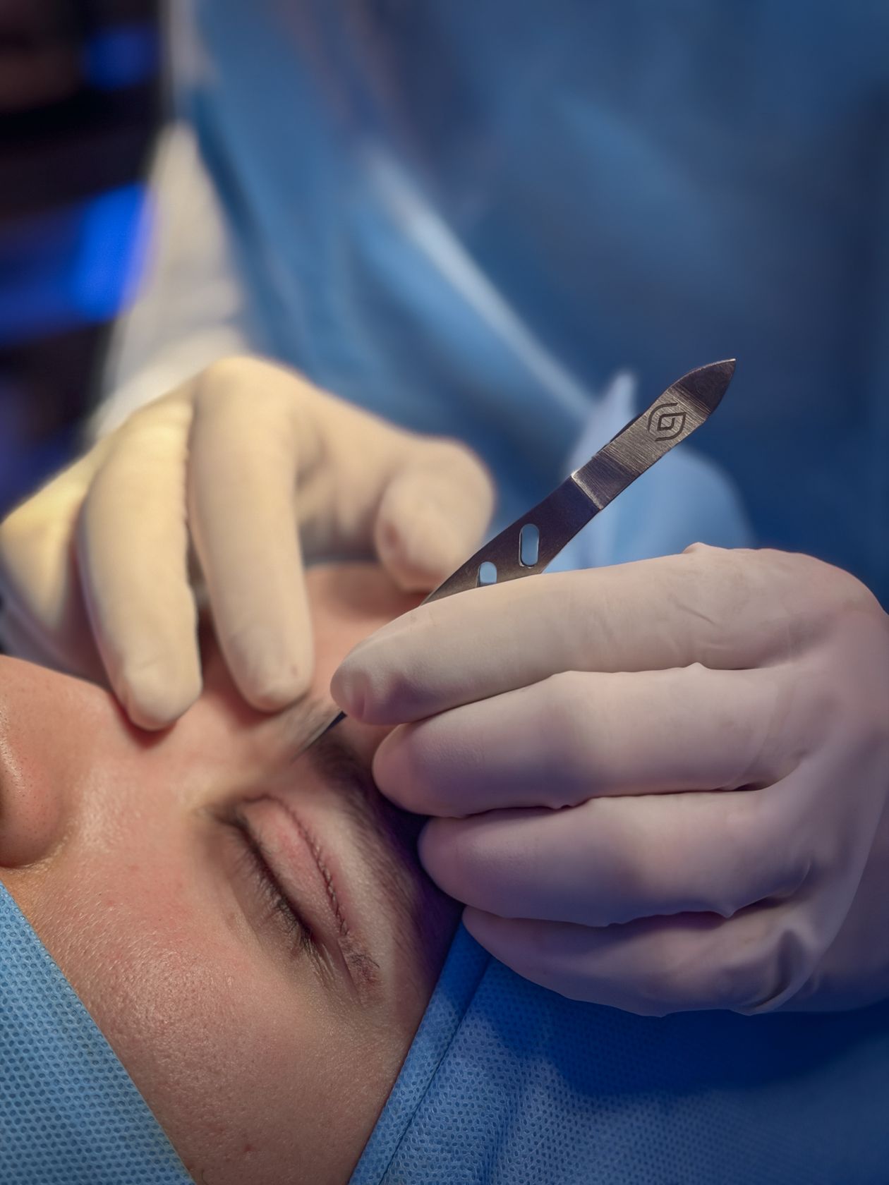 Procedimento de cirurgia plástica ocular realizado pelo Dr. Cadu Salomão
